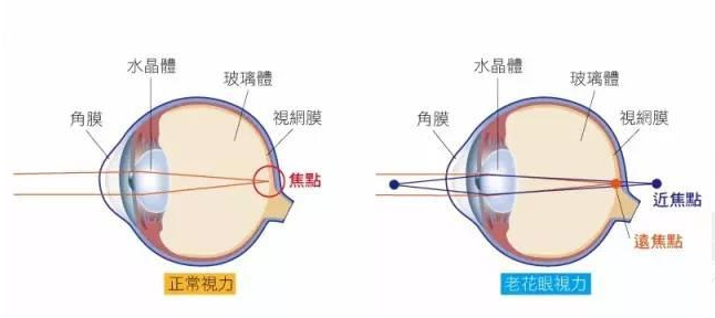 白內障和老花眼區(qū)別，老花眼發(fā)病率正呈現(xiàn)年輕化趨勢