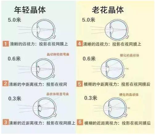 近視就不會(huì)老花了嗎？